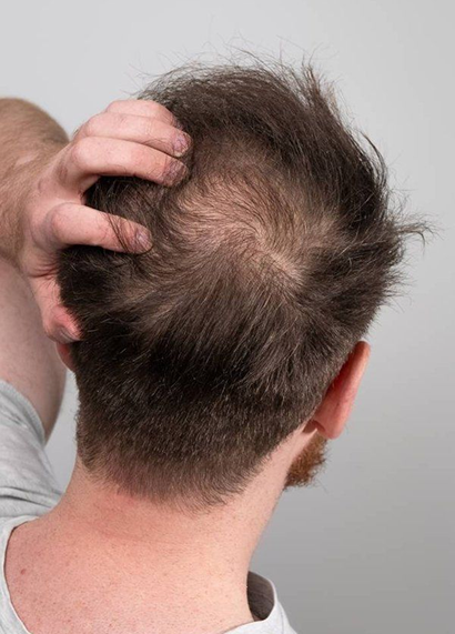 What causes hair fall?